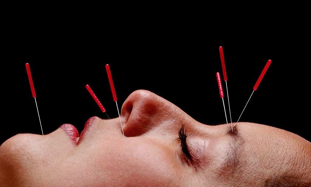 Woman undergoing acupuncture treatment on face, close-up